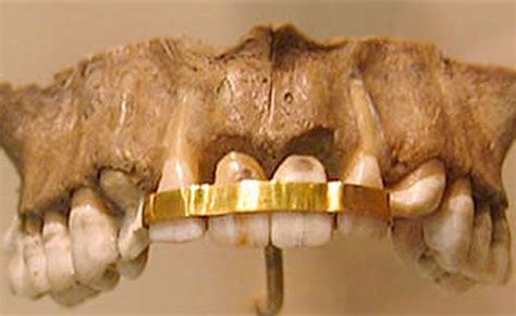 The Cultural Significance of Gold Teeth in Different Regions